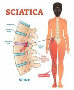 Yoga And Sciatica: Safe Poses To Avoid Further Pain 1 Sciatica